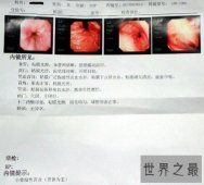 【图】肠系膜淋巴结炎的了会很严重吗 怎么治疗