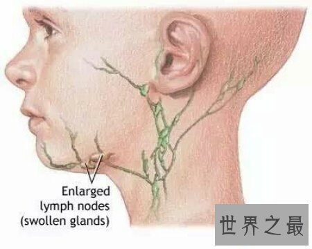 【图】肠系膜淋巴结炎的了会很重大吗 怎样治疗