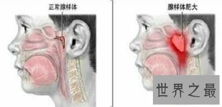 【图】肠系膜淋巴结炎的了会很重大吗 怎样治疗