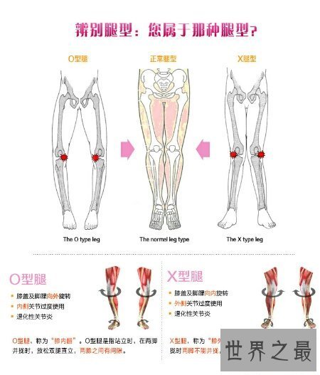【图】冬季来临为了穿短裤矫正腿型真的很重要