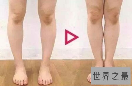 【图】冬季来临为了穿短裤矫正腿型真的很重要