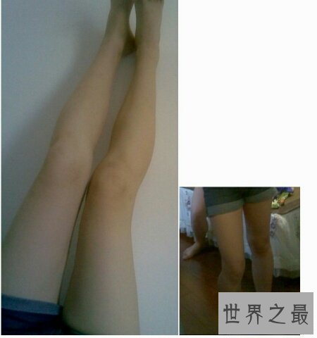 【图】冬季来临为了穿短裤矫正腿型真的很重要