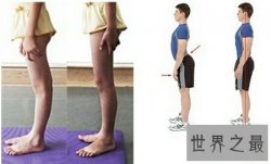 【图】夏季来临为了穿短裤矫正腿型真的很重要