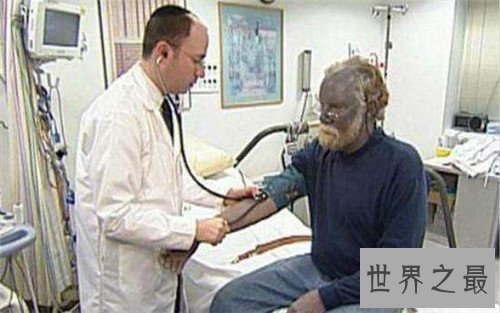 【图】蓝色人种切实存在 皮肤变成蓝色竟然和血液无关