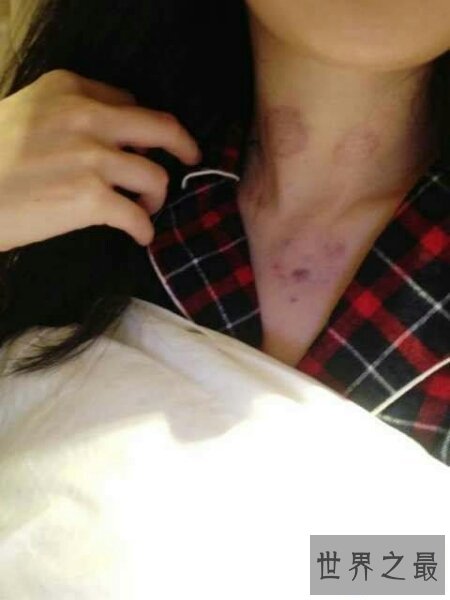 【图】竟然有人不知道种草莓什么意思 其实就是吻痕