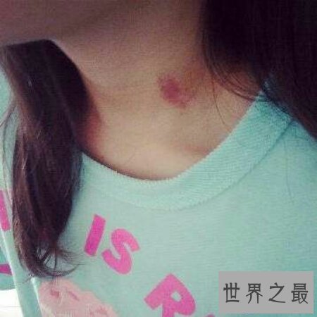 【图】竟然有人不知道种草莓什么意思 其实就是吻痕