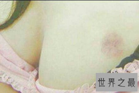 【图】竟然有人不知道种草莓什么意思 其实就是吻痕