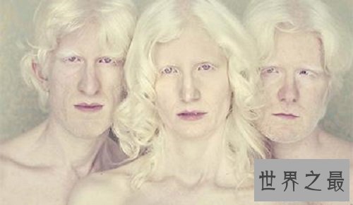 【图】白化病是一种没有药物医治的后天病