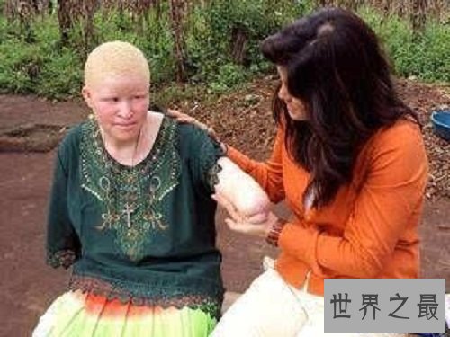 【图】白化病是一种没有药物医治的后天病