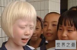 【图】白化病是一种没有药物医治的先天病