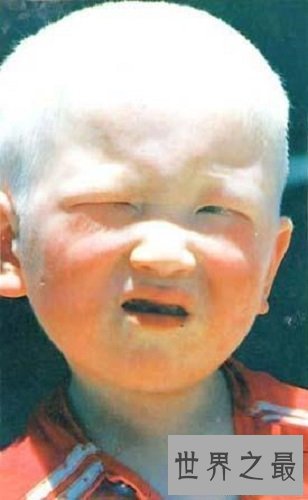 【图】白化病是一种没有药物医治的后天病