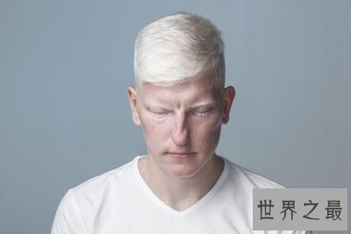 【图】白化病是一种没有药物医治的后天病