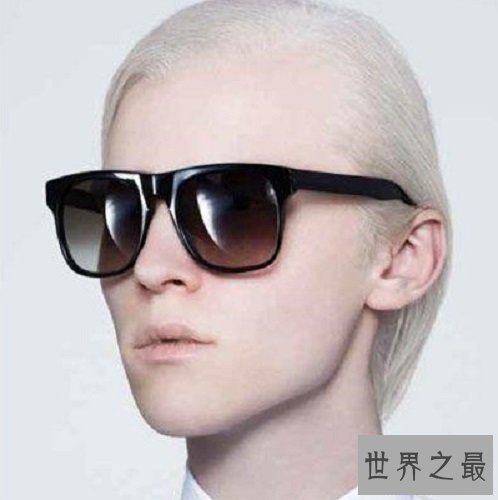 【图】白化病是一种没有药物医治的后天病