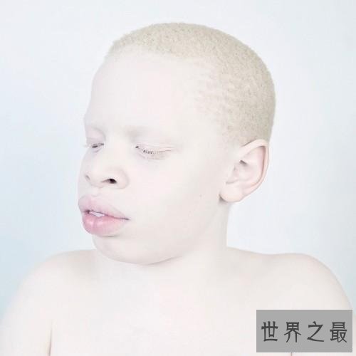 【图】白化病是一种没有药物医治的后天病