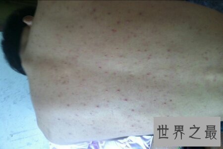 【图】前胸后背长痘痘 学会这些小妙招微微松松处理