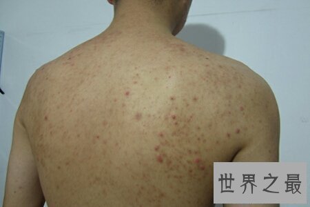 【图】前胸后背长痘痘 学会这些小妙招微微松松处理
