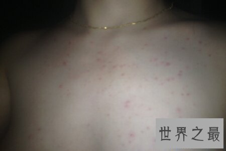 【图】前胸后背长痘痘 学会这些小妙招微微松松处理