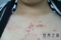 【图】前胸后背长痘痘 学会这些小妙招轻轻松松解决