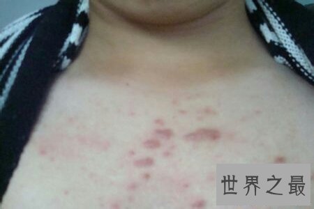 【图】前胸后背长痘痘 学会这些小妙招微微松松处理