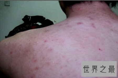 【图】前胸后背长痘痘 学会这些小妙招微微松松处理