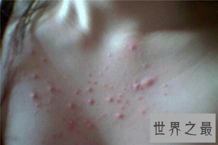 【图】前胸后背长痘痘 学会这些小妙招微微松松处理