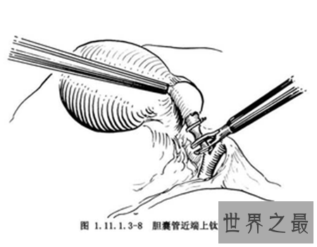 【图】切除胆囊的结果很重大 万不得已不能切除胆囊