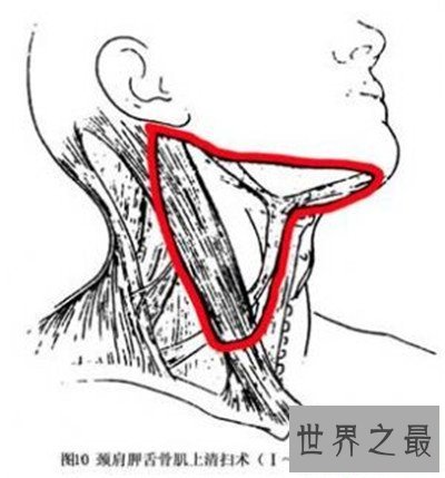 【图】颈部淋巴结分区引见 淋巴结肿大的缘由引见