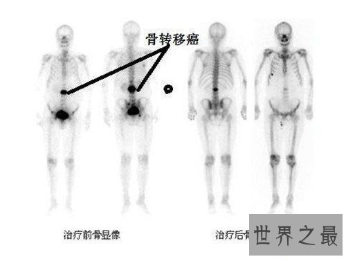 【图】乳腺癌骨转移能治疗吗 怎么可能疼痛缓解