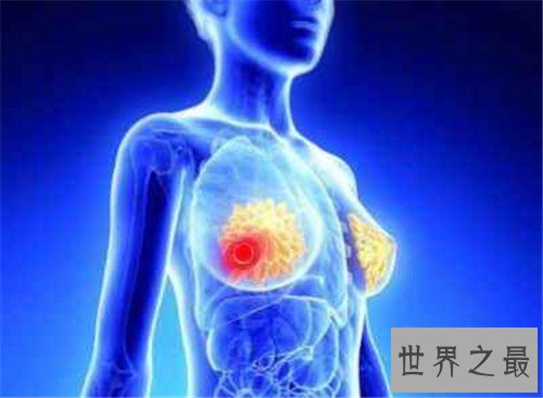 【图】乳腺癌骨转移能治疗吗 怎么可能疼痛缓解