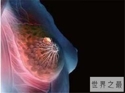 【图】乳腺癌骨转移能治疗吗 怎么可能疼痛缓解
