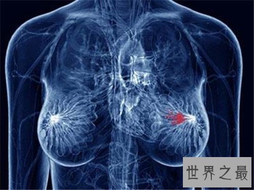 【图】乳腺癌骨转移能治疗吗 怎么可能疼痛缓解