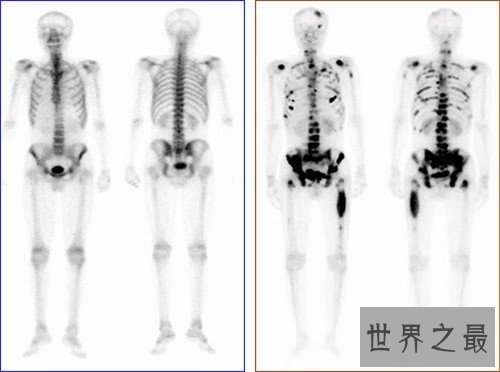 【图】乳腺癌骨转移能治疗吗 怎么可能疼痛缓解