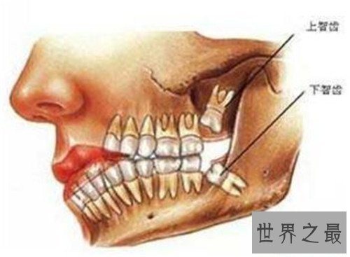 【图】尽头牙是什么意思 智齿真的肯定要拔出吗