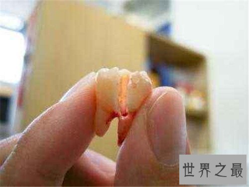 【图】尽头牙是什么意思 智齿真的肯定要拔出吗