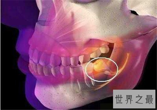 【图】尽头牙是什么意思 智齿真的肯定要拔出吗
