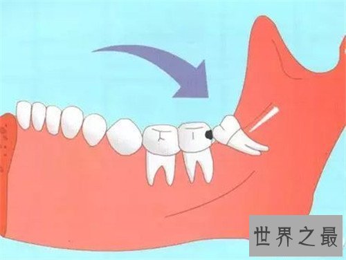 【图】尽头牙是什么意思 智齿真的肯定要拔出吗