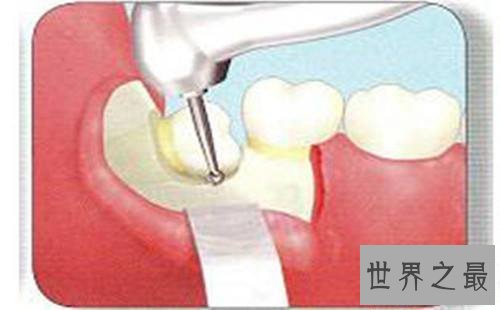 【图】尽头牙是什么意思 智齿真的肯定要拔出吗