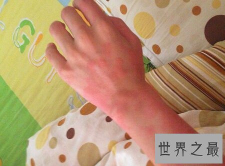 【图】荨麻疹是一种比较难治的症状 荨麻疹偏方是什么