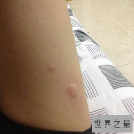 【图】荨麻疹是一种比较难治的症状 荨麻疹偏方是什么