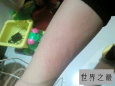 【图】荨麻疹是一种比较难治的症状 荨麻疹偏方是什么