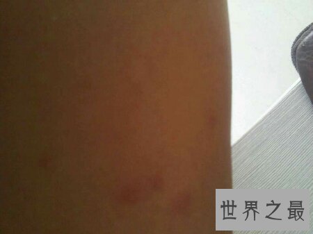 【图】荨麻疹是一种比较难治的症状 荨麻疹偏方是什么