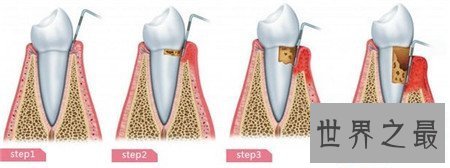 【图】牙龈炎图片 快出去对比一下你有没有牙龈炎