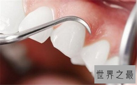 【图】牙龈炎图片 快出去对比一下你有没有牙龈炎