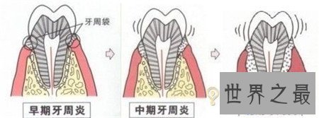 【图】牙龈炎图片 快出去对比一下你有没有牙龈炎