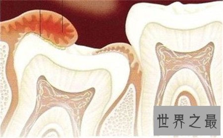 【图】牙龈炎图片 快出去对比一下你有没有牙龈炎