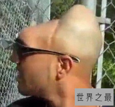 【图】话说美国有一个半脑哥 可是他到底是怎么活上去