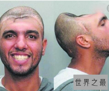 【图】话说美国有一个半脑哥 可是他到底是怎么活上去