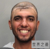 【图】话说美国有一个半脑哥 可是他到底是怎样活下来