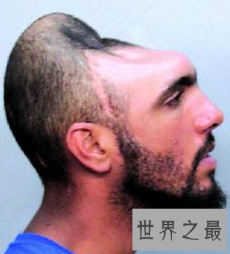 【图】话说美国有一个半脑哥 可是他到底是怎么活上去