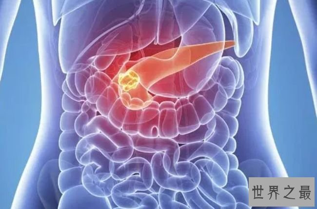 胰腺癌